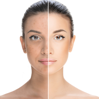 Acne treatment in lucknow