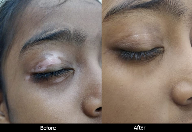 Laser treatment in lucknow