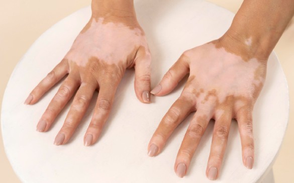 Vitiligo treatment in Lucknow.